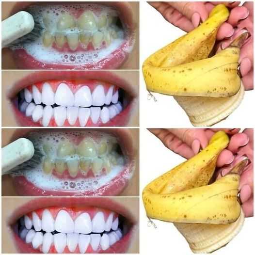 Fast TEETH WHITENING in 1 minute!
