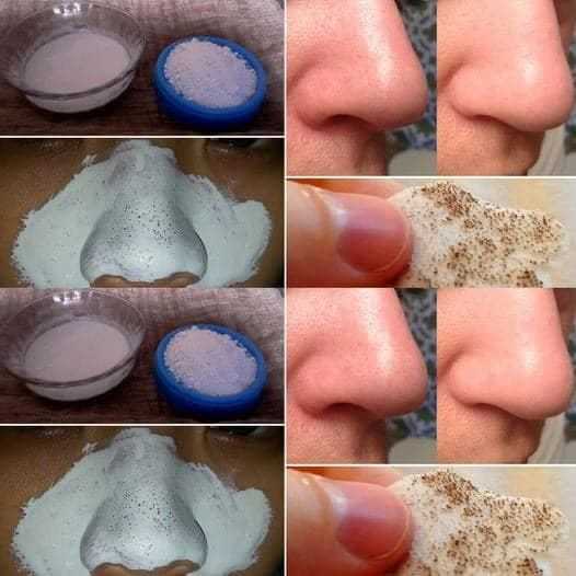 How to remove blackheads naturally
